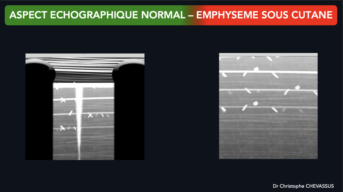 Aspect échographique de l'emphysème sous cutané versus aspect échographique de la paroi thoracique normale