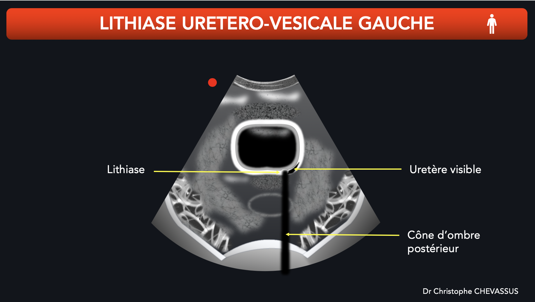 Lithiase urétéro-vésicale