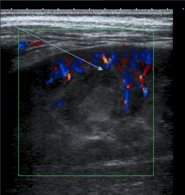 Abcès rénal : image ronde hype-échogène non vascularisée